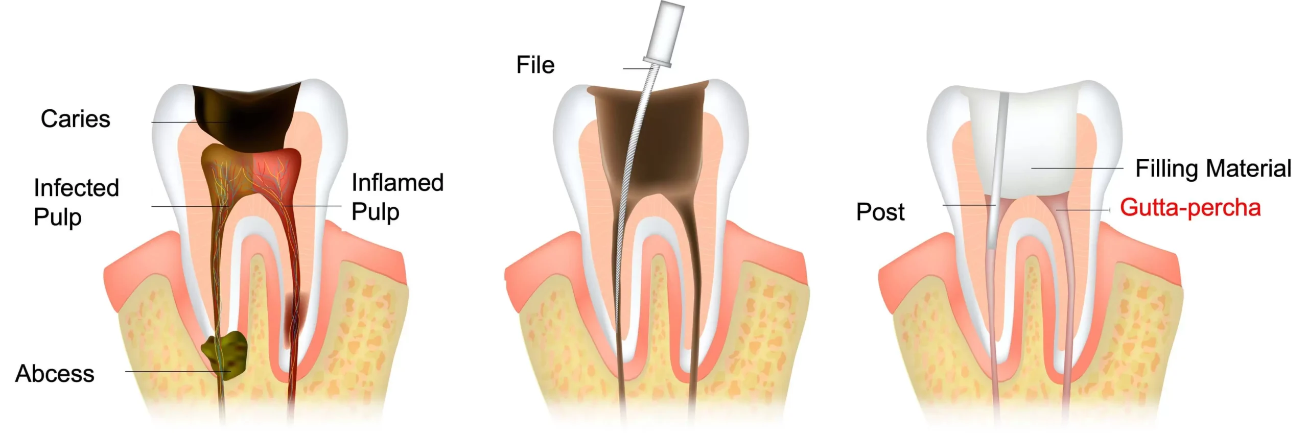 What is gutta percha?